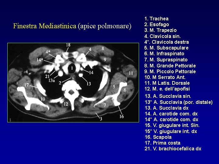 Finestra Mediastinica (apice polmonare) 1. Trachea 2. Esofago 3. M. Trapezio 4. Clavicola sin.