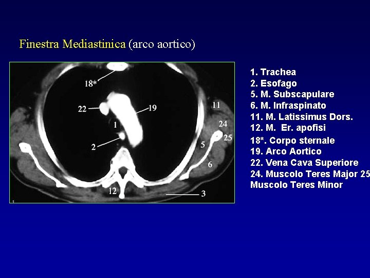 Finestra Mediastinica (arco aortico) 1. Trachea 2. Esofago 5. M. Subscapulare 6. M. Infraspinato