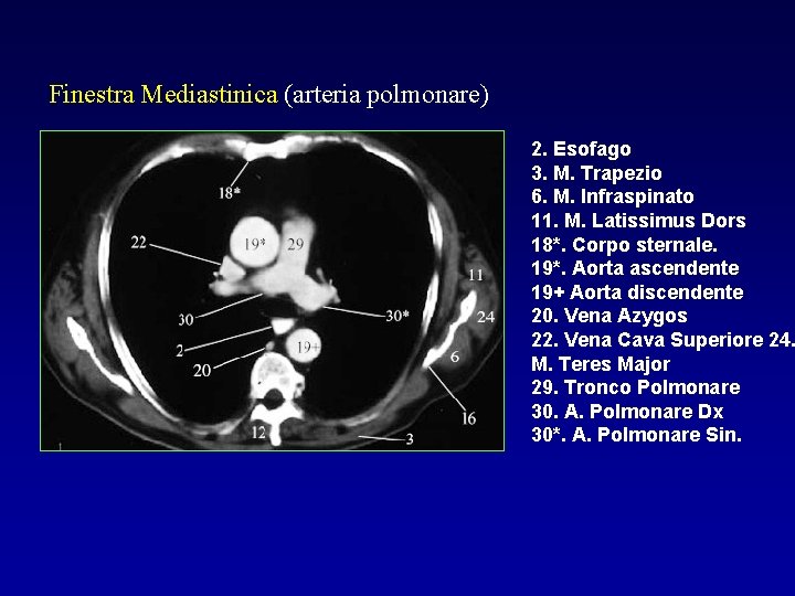 Finestra Mediastinica (arteria polmonare) 2. Esofago 3. M. Trapezio 6. M. Infraspinato 11. M.
