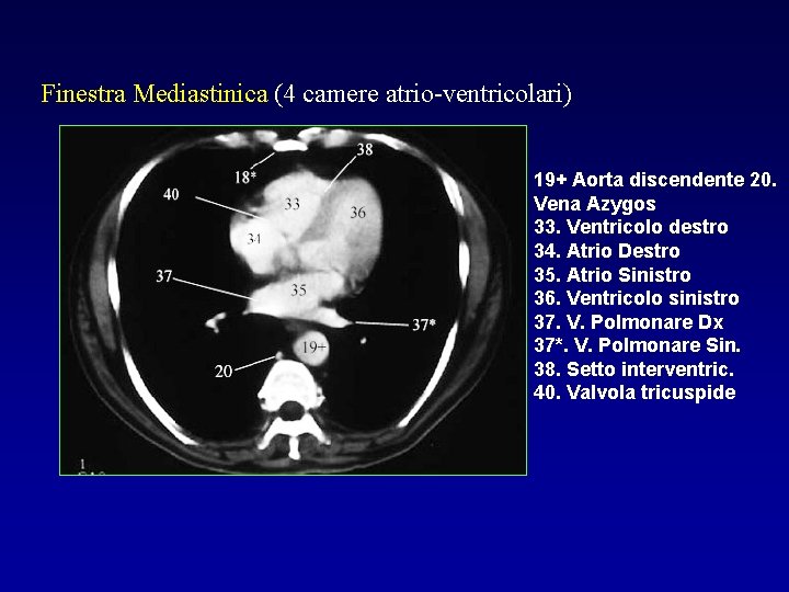 Finestra Mediastinica (4 camere atrio-ventricolari) 19+ Aorta discendente 20. Vena Azygos 33. Ventricolo destro