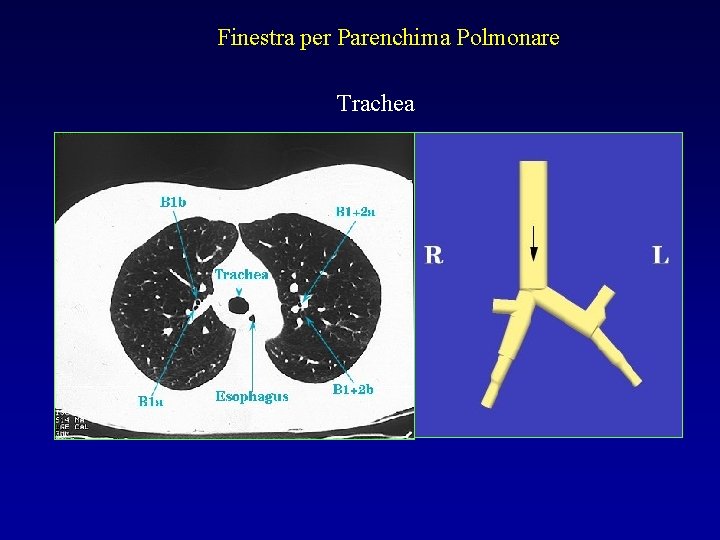 Finestra per Parenchima Polmonare Trachea 