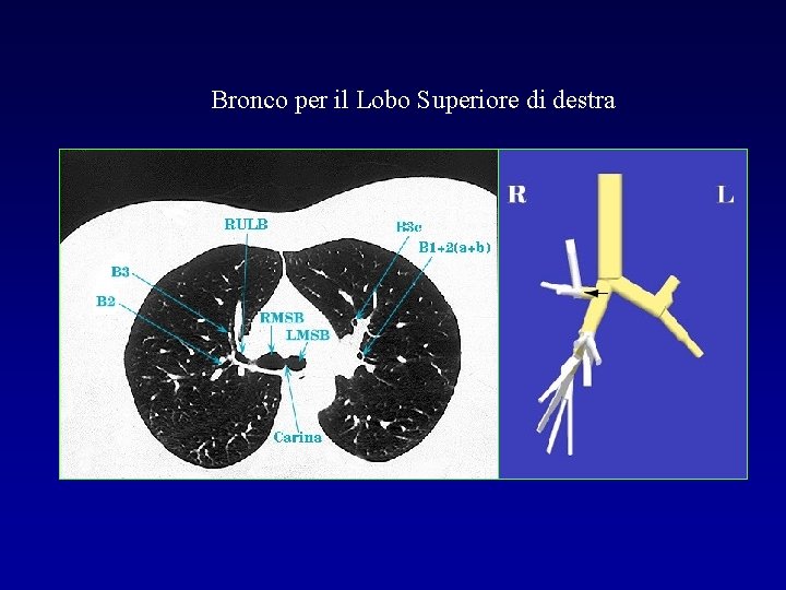 Bronco per il Lobo Superiore di destra 