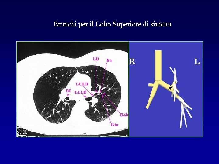 Bronchi per il Lobo Superiore di sinistra 