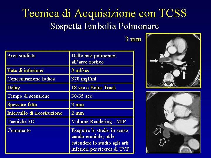 Tecnica di Acquisizione con TCSS Sospetta Embolia Polmonare 3 mm Area studiata Dalle basi