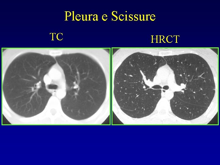 Pleura e Scissure TC HRCT 