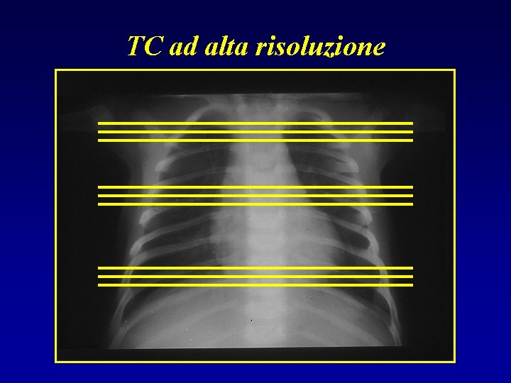 TC ad alta risoluzione 