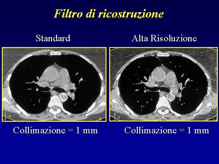 Filtro di ricostruzione Standard Alta Risoluzione Collimazione = 1 mm 