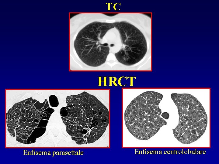 TC HRCT Enfisema parasettale Enfisema centrolobulare 