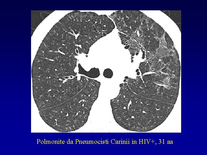 Polmonite da Pneumocisti Carinii in HIV+, 31 aa 