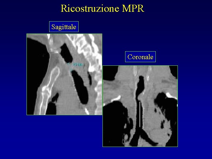 Ricostruzione MPR Sagittale Coronale 