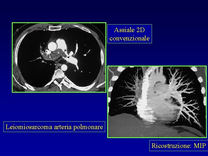 Assiale 2 D convenzionale Leiomiosarcoma arteria polmonare Ricostruzione: MIP 