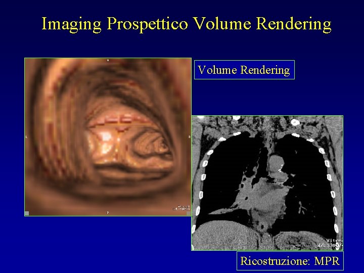 Imaging Prospettico Volume Rendering Ricostruzione: MPR 