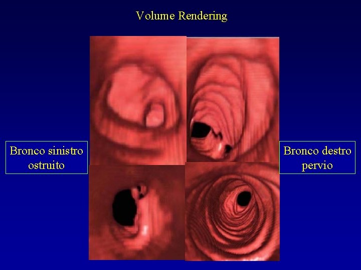 Volume Rendering Bronco sinistro ostruito Bronco destro pervio 