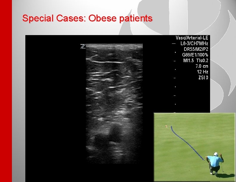 Special Cases: Obese patients 