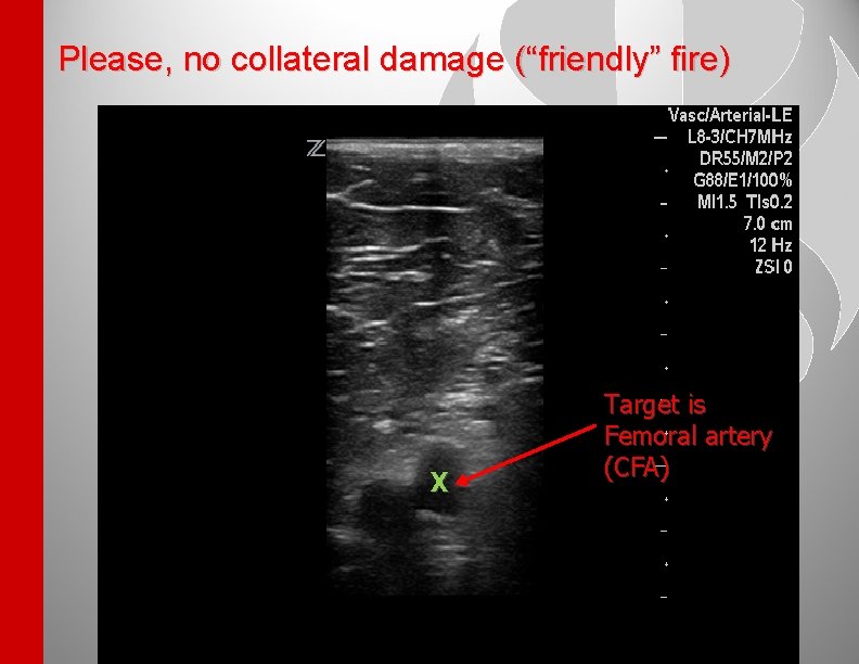 Please, no collateral damage (“friendly” fire) X Target is Femoral artery (CFA) 