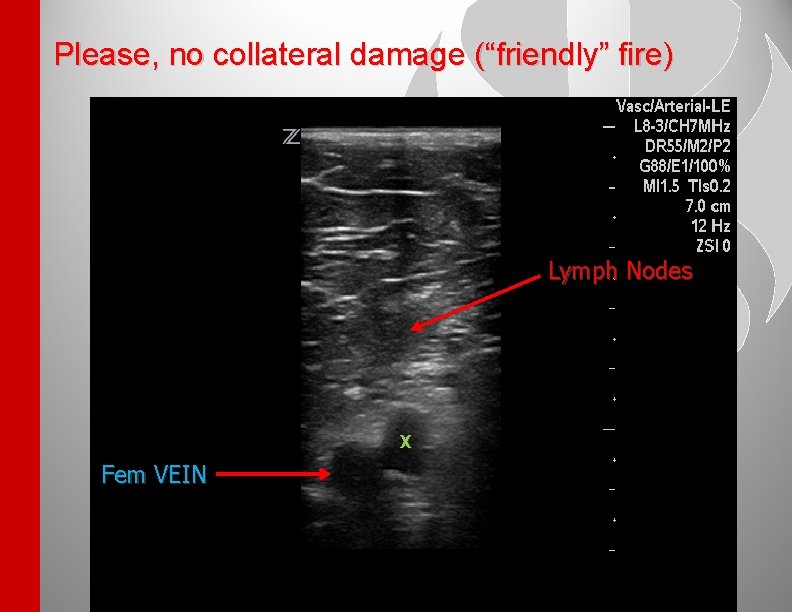 Please, no collateral damage (“friendly” fire) Lymph Nodes X Fem VEIN 