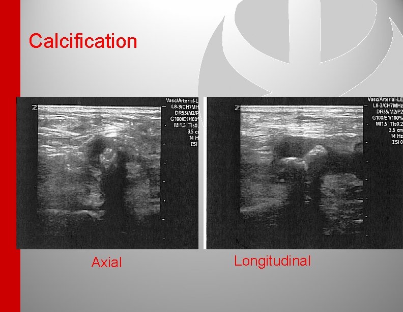 Calcification Axial Longitudinal 