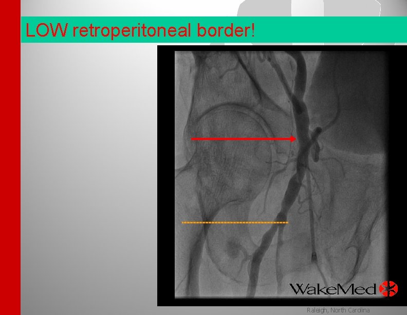 LOW retroperitoneal border! Wake. Med Health & Hospitals Raleigh, North Carolina 