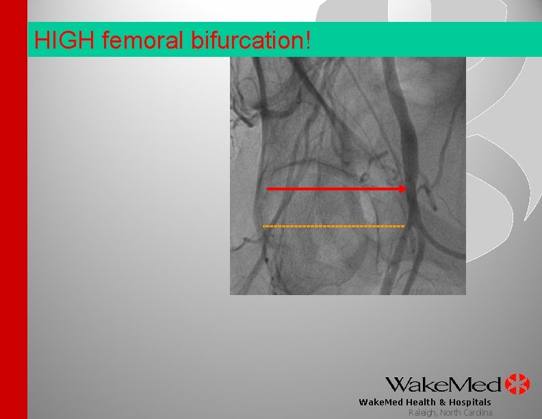 HIGH femoral bifurcation! Wake. Med Health & Hospitals Raleigh, North Carolina 