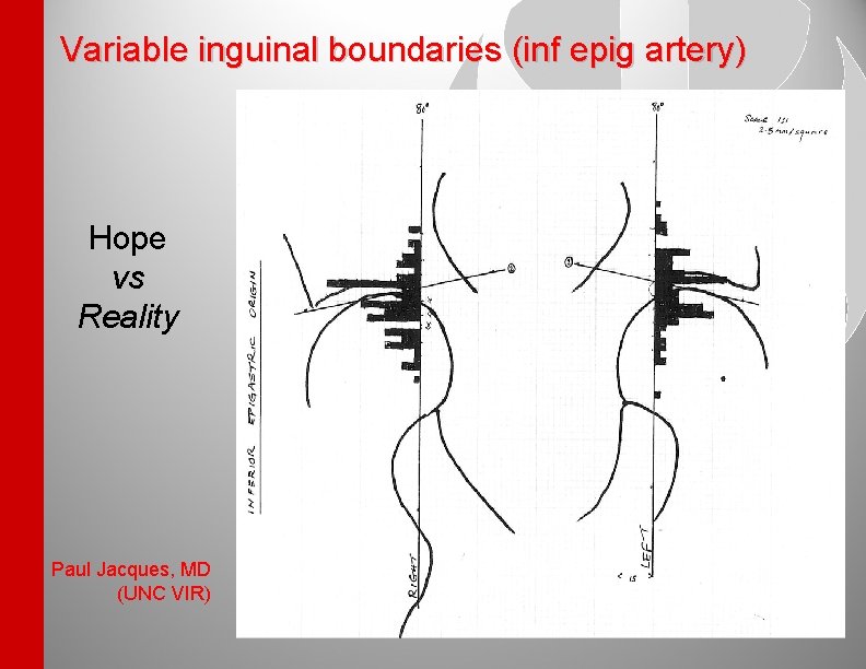 Variable inguinal boundaries (inf epig artery) Hope vs Reality Paul Jacques, MD (UNC VIR)