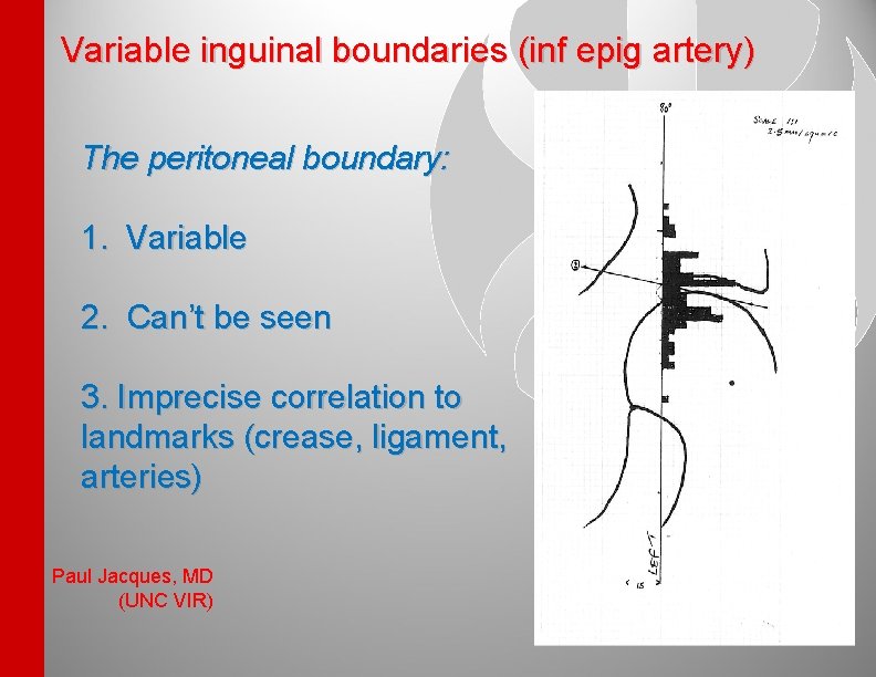 Variable inguinal boundaries (inf epig artery) The peritoneal boundary: 1. Variable 2. Can’t be