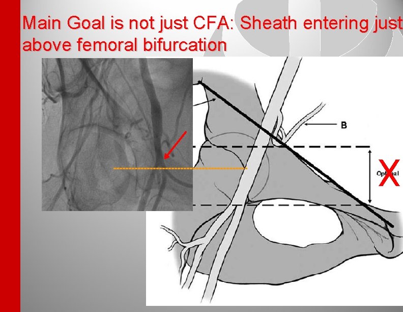 Main Goal is not just CFA: Sheath entering just above femoral bifurcation X 