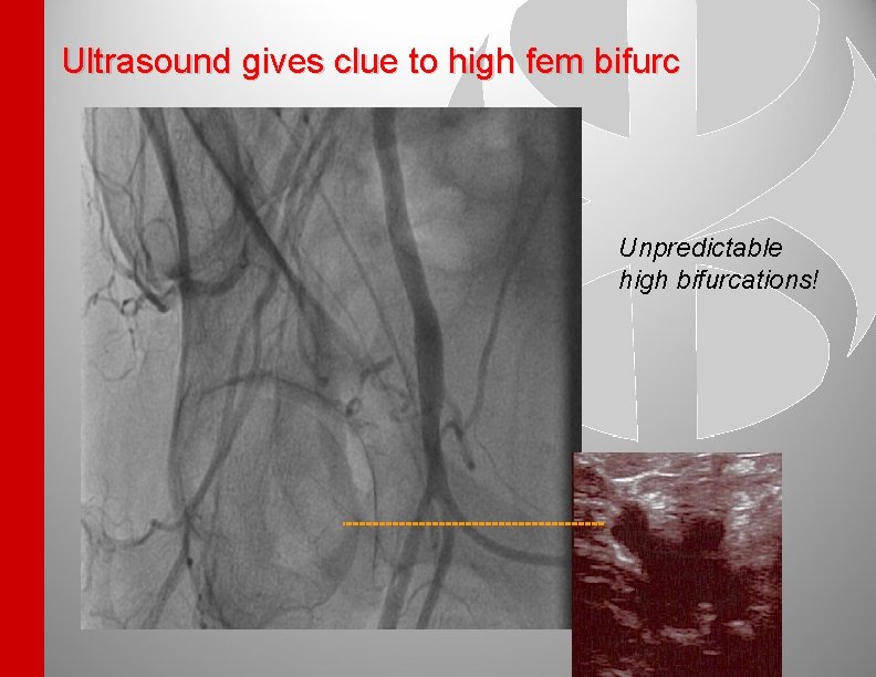 Ultrasound gives clue to high fem bifurc Unpredictable high bifurcations! 