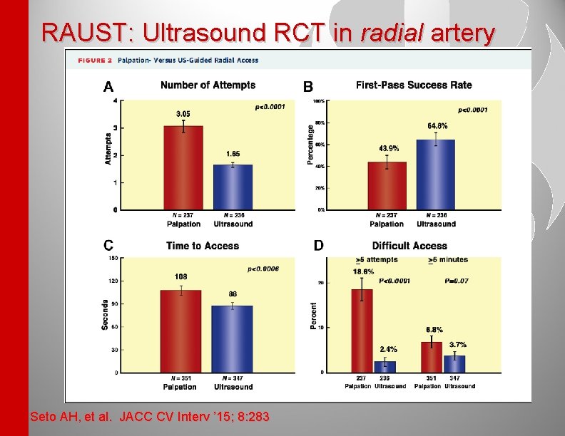 RAUST: Ultrasound RCT in radial artery Seto AH, et al. JACC CV Interv ’