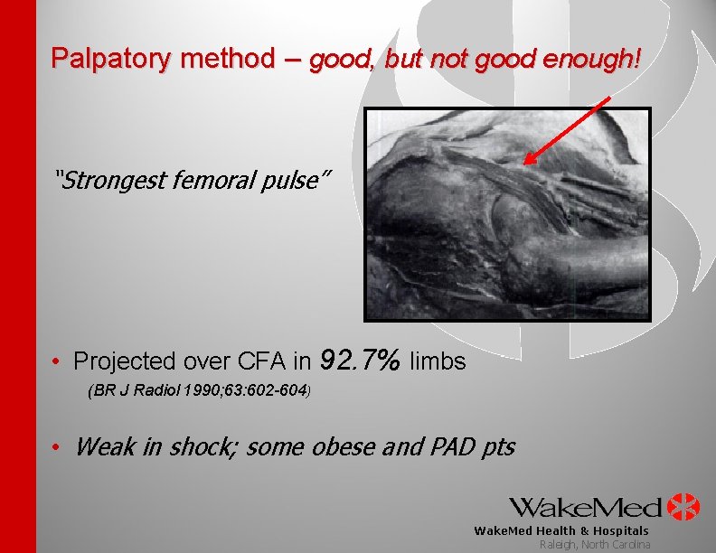 Palpatory method – good, but not good enough! “Strongest femoral pulse” • Projected over