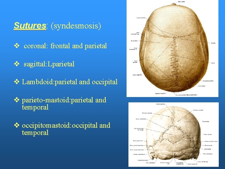 Sutures: (syndesmosis) v coronal: frontal and parietal v sagittal: Lparietal v Lambdoid: parietal and