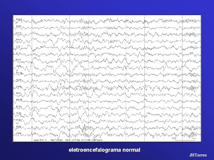eletroencefalograma normal JHTorres 