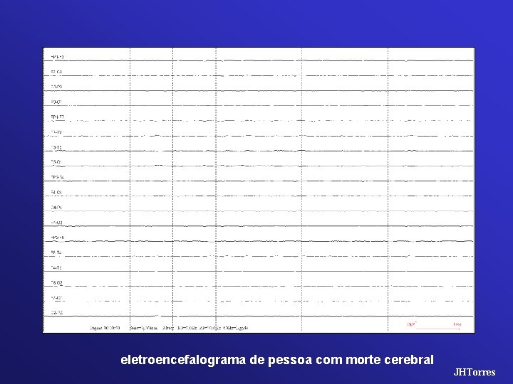 eletroencefalograma de pessoa com morte cerebral JHTorres 