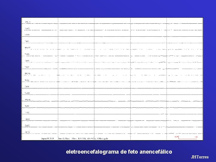 eletroencefalograma de feto anencefálico JHTorres 