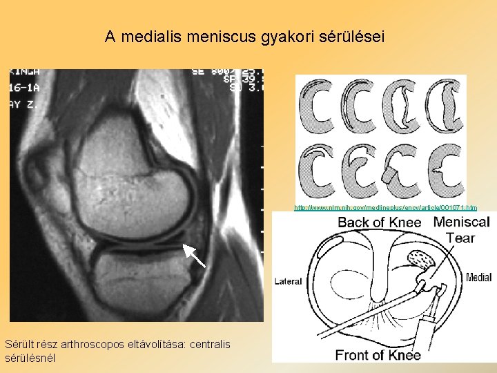 A medialis meniscus gyakori sérülései http: //www. nlm. nih. gov/medlineplus/ency/article/001071. htm Sérült rész arthroscopos