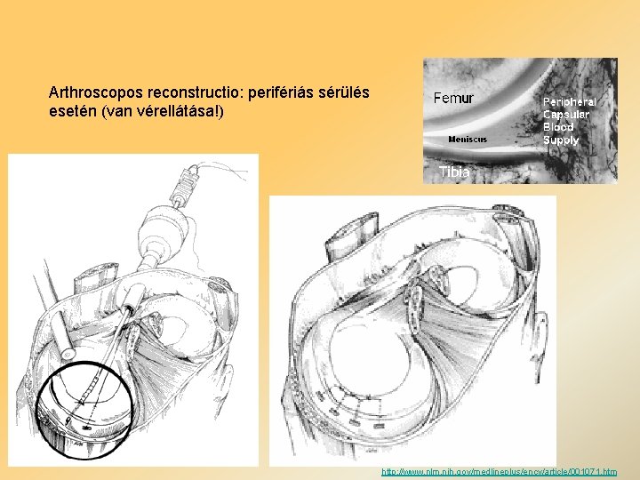 Arthroscopos reconstructio: perifériás sérülés esetén (van vérellátása!) http: //www. nlm. nih. gov/medlineplus/ency/article/001071. htm 