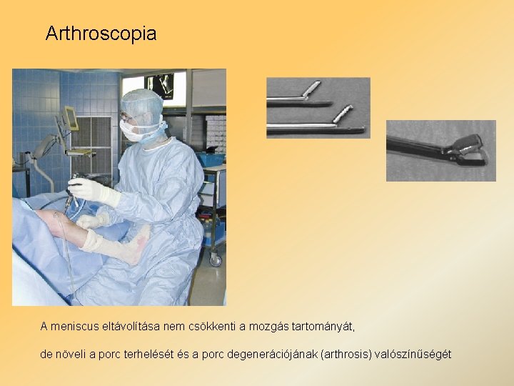 Arthroscopia A meniscus eltávolítása nem csökkenti a mozgás tartományát, de növeli a porc terhelését