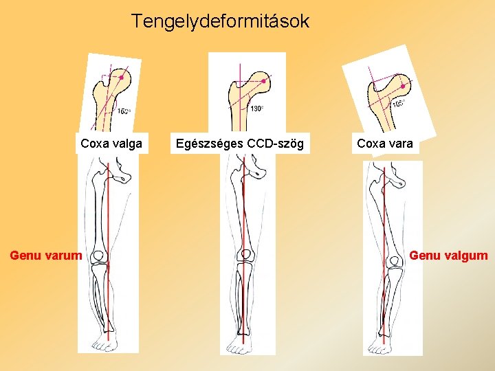 Tengelydeformitások Coxa valga Genu varum Egészséges CCD-szög Coxa vara Genu valgum 