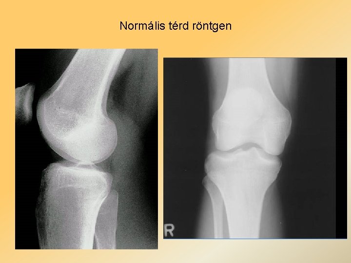 Normális térd röntgen 