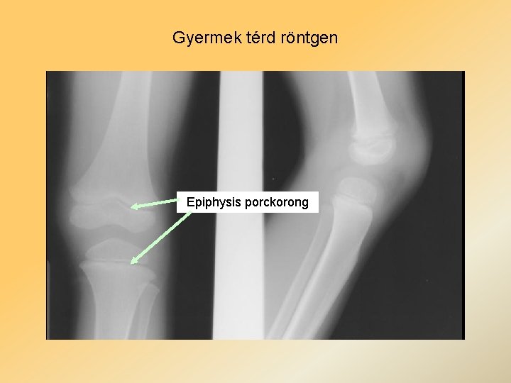 Gyermek térd röntgen Epiphysis porckorong 