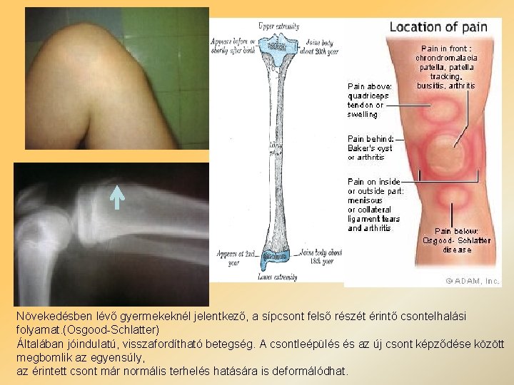 Növekedésben lévő gyermekeknél jelentkező, a sípcsont felső részét érintő csontelhalási folyamat. (Osgood-Schlatter) Általában jóindulatú, Növekedésben lévő gyermekeknél jelentkező, a sípcsont felső részét érintő csontelhalási folyamat. (Osgood-Schlatter) Általában jóindulatú,