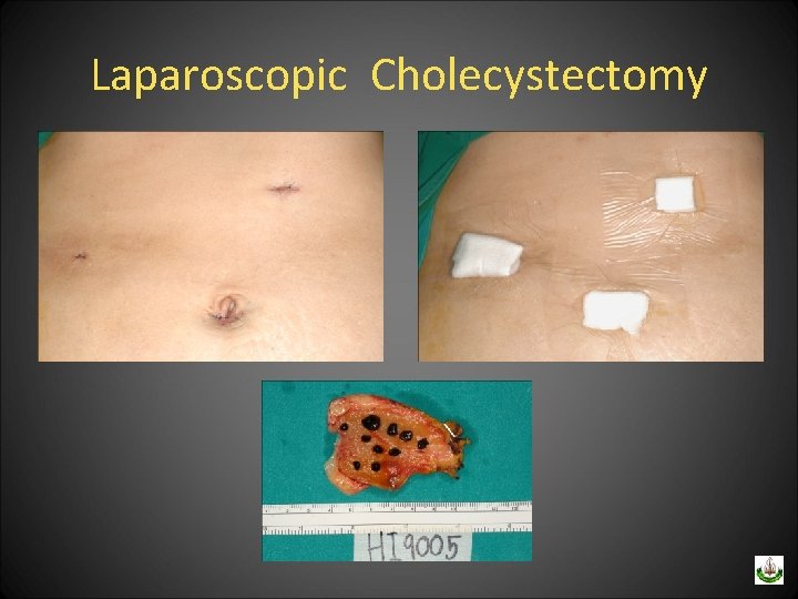 Laparoscopic Cholecystectomy 