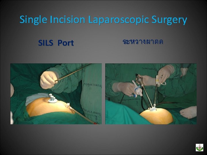 Single Incision Laparoscopic Surgery SILS Port ระหวางผาตด 