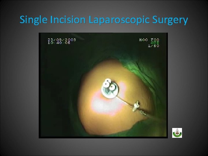 Single Incision Laparoscopic Surgery 