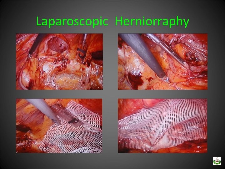 Laparoscopic Herniorraphy 