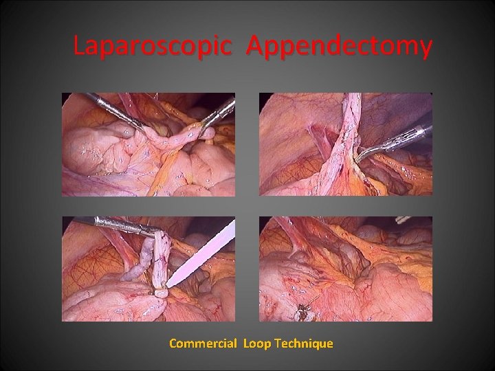 Laparoscopic Appendectomy Commercial Loop Technique 