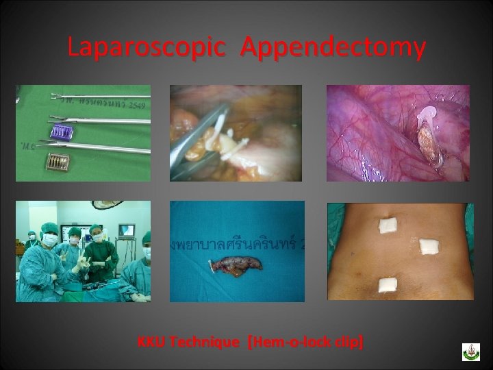 Laparoscopic Appendectomy KKU Technique [Hem-o-lock clip] 