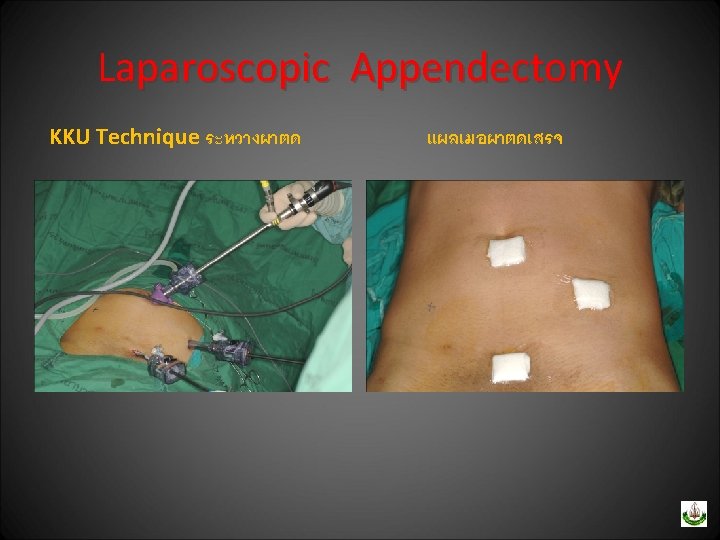 Laparoscopic Appendectomy KKU Technique ระหวางผาตด แผลเมอผาตดเสรจ 