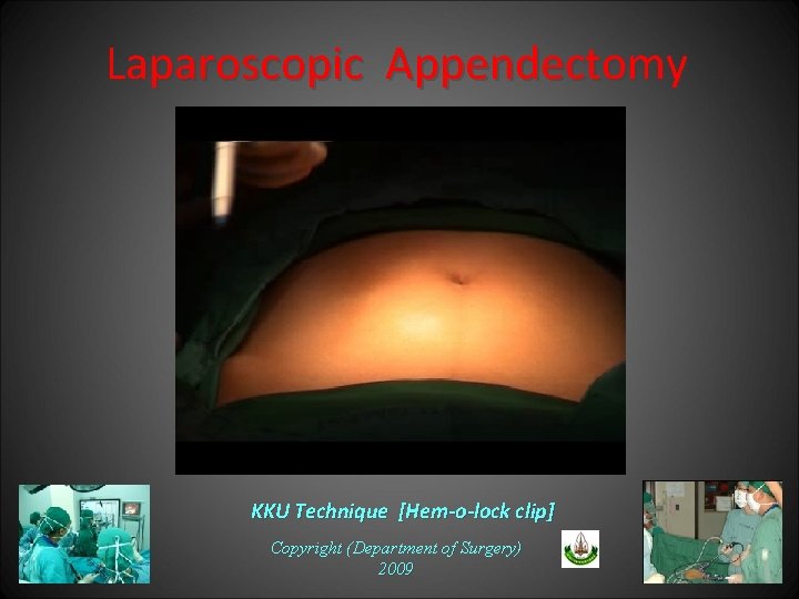 Laparoscopic Appendectomy KKU Technique [Hem-o-lock clip] Copyright (Department of Surgery) 2009 