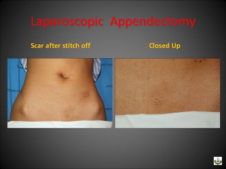 Laparoscopic Appendectomy Scar after stitch off Closed Up 