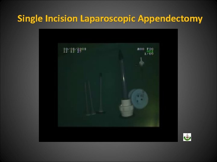 Single Incision Laparoscopic Appendectomy 